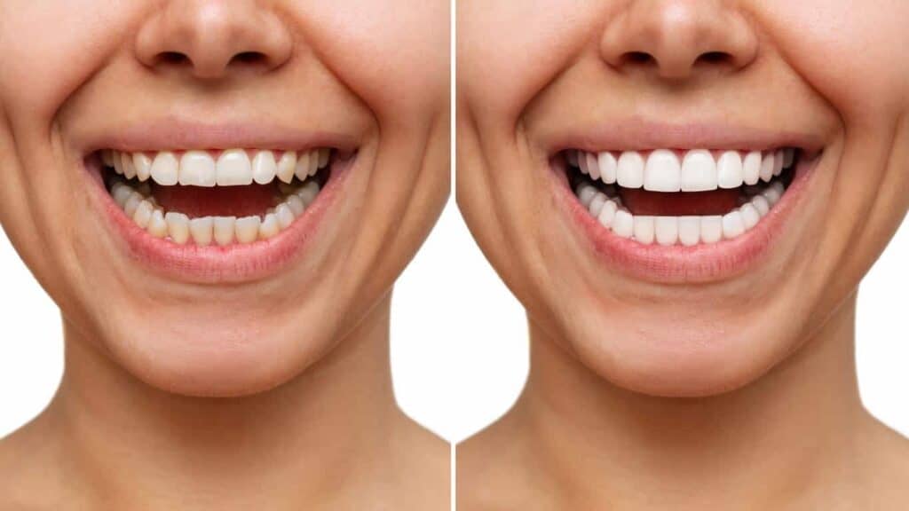 Contact Aspire White for teeth whitening services – Get in touch with Bedford today