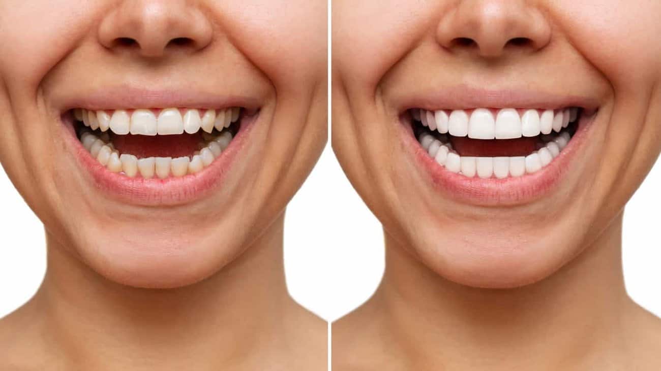 Contact Aspire White for teeth whitening services – Get in touch with Bedford today