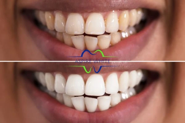 Aspire White customer before and after Bedford results.