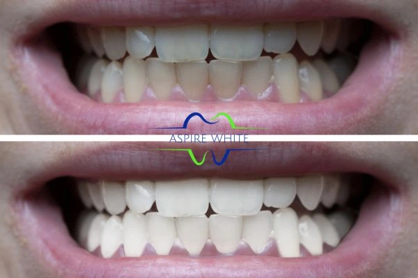 1 hour laser teeth whitening before and after results Bedford