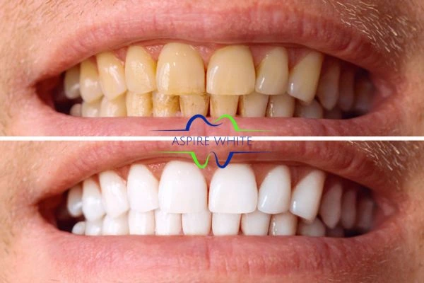 Get noticeable whiter smile in just one hour! Book your teeth whitening treatment Bedford today!