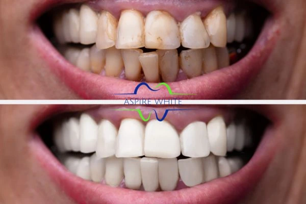 Before and after results of laser teeth whitening Bedford Book in online today!
