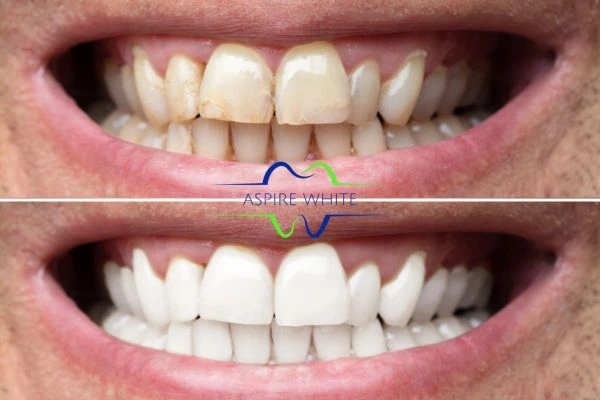 Achieve a radiant smile with professional laser teeth whitening Bedford